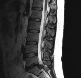 Dijagnostičke mogućnosti za lumbalnu osteohondrozu