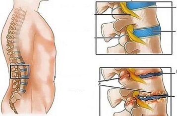 Razlozi razvoja lumbalne osteohondroze