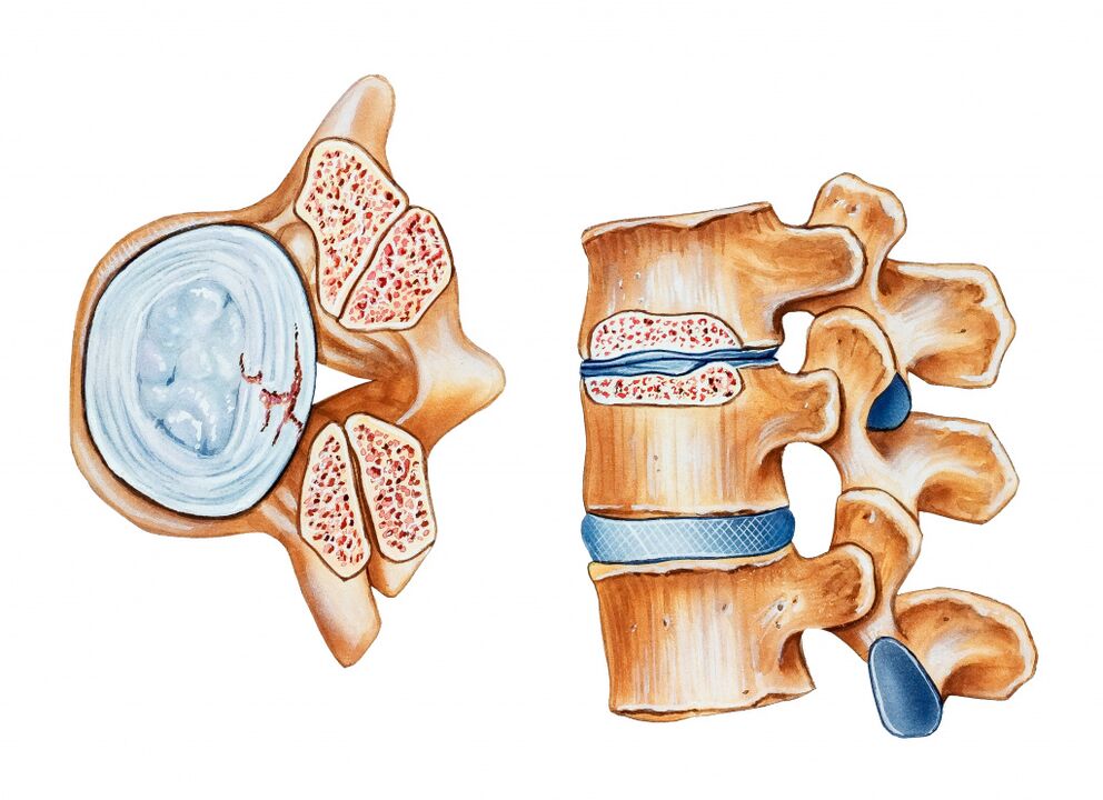 Osteohondroza cervikalne regije dovodi do uništenja intervertebralnih diskova